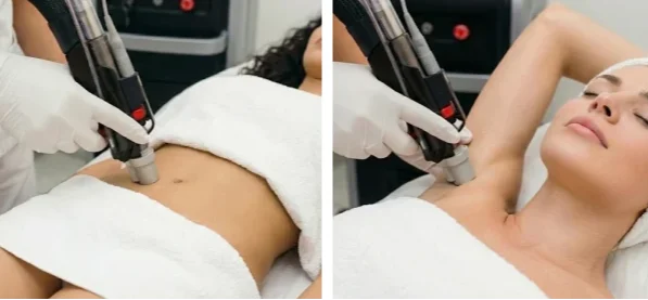 КОМПЛЕКТ: подмышки и бикини полностью (Обычная цена 174€)